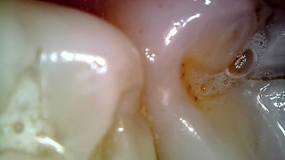 Medical Endoscope Oral Exam: Gummy Chewing, Extreme Teeth & Tongue Macro